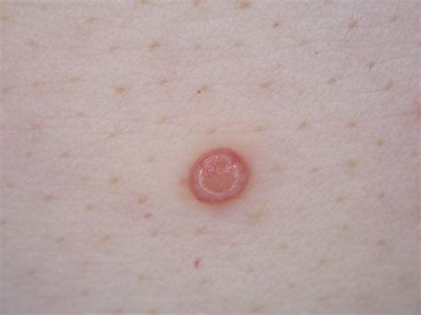 Molluscum contagiosum - Dr Jonathan Bowling