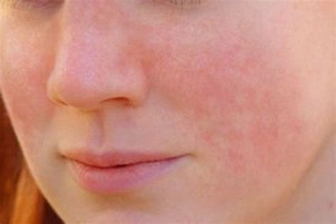 Discoid Lupus Rash On Face