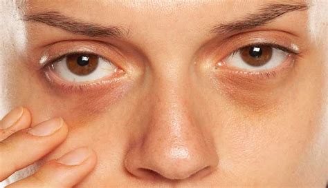 Health And Beauty: Dark circles under your eyes? Causes and remedies - Dynamite News