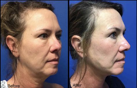 Woman with Face & Neck Lift - Before and After - Carolina Coastal ...