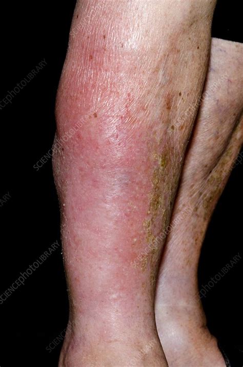 Cellulitis on the leg - Stock Image - C015/5929 - Science Photo Library