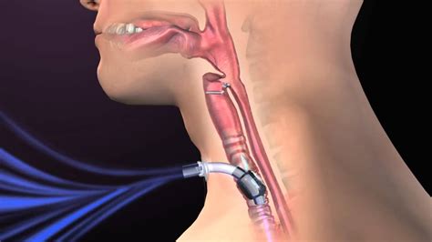 Clinical Complications of Tracheostomy - YouTube