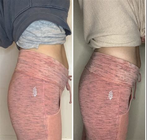 amyBeforeAndAfterButtLift | Rochester A-List