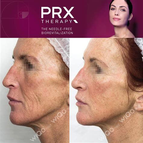 Everything you need to know about our fabulous PRX-T33 Therapy