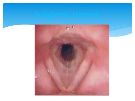 Laryngeal edema and stenosis - презентация онлайн