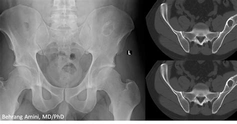 Roentgen Ray Reader: Chronic Subperiosteal Iliac Hematoma