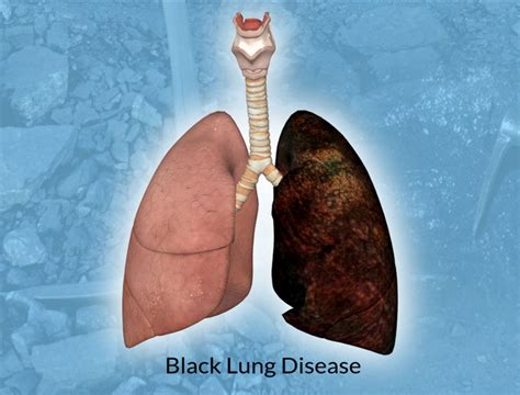 MEC&F Expert Engineers : Rapid Progression of Black Lung Disease ...