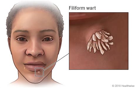 Filiform warts - MedicalRecords.com