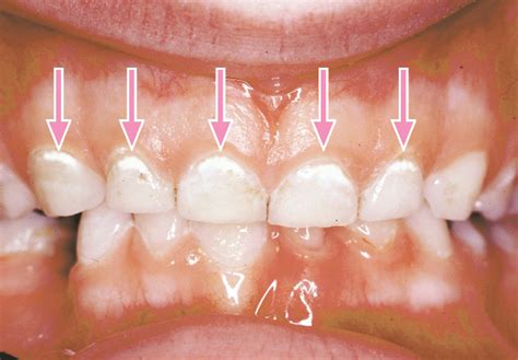 Early Cavities In Baby Teeth - Get More Anythink's