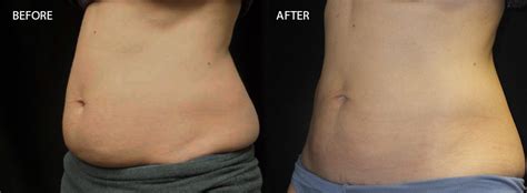 CoolSculpting™ | Sanders Medical Inc