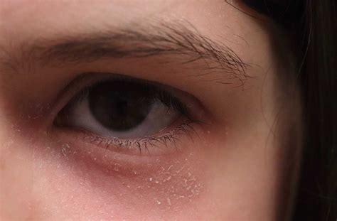 What Causes Dry Eyelids (Blepharitis)? | Okotoks Eye Care