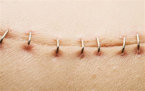 Surgical staples | Medical stitches, Scar, Hysterectomy