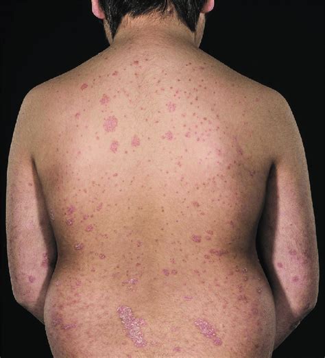 Mixed plaque and guttate psoriasis on the back of a 9-year-old boy ...