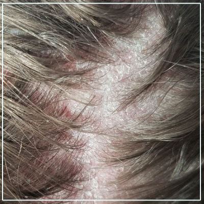 Dermatitis On Scalp