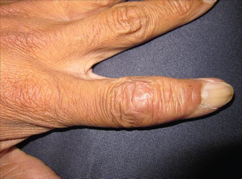 Subcutaneous Nodules on the Fingers—Quiz Case | Dermatology | JAMA Dermatology | The JAMA Network