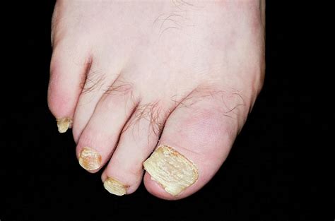 Psoriasis Of The Toenails Photograph by Dr P. Marazzi/science Photo Library
