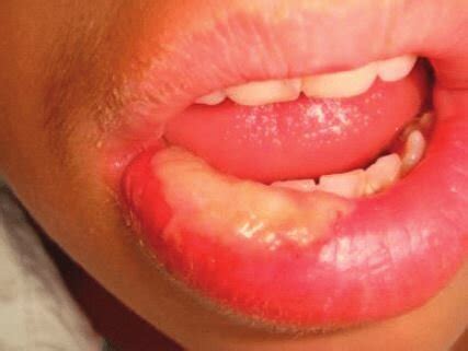 What to do for lip biting after a dental procedure — Heights Pediatric Dentistry & Orthodontics