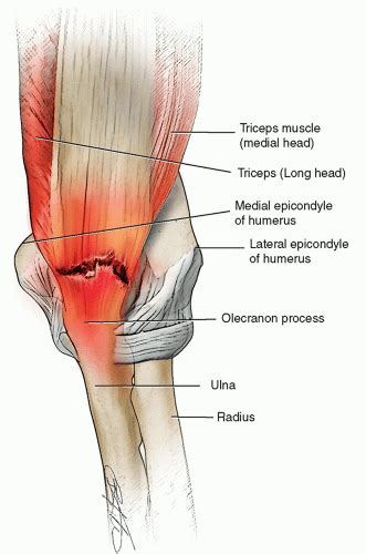 Torn Triceps Tendon – A Rare But Serious Injury | SportsMD