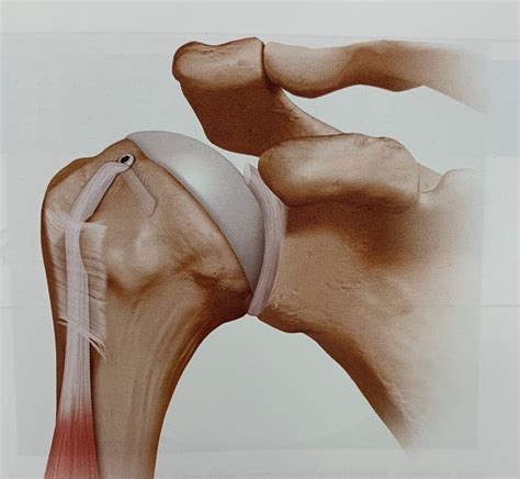 Biceps Tenodesis | Shoulder Injuries | Dr. Christopher Ahmad