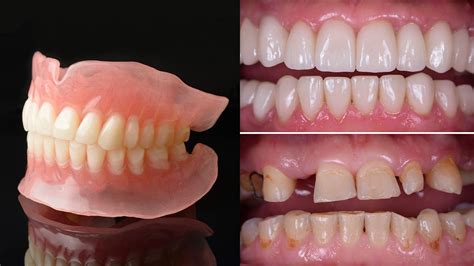 Dentures Before And After Pictures | What To Expect