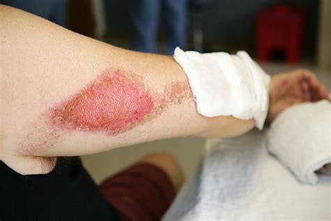 How To Treat Road Rash | Bachus & Schanker Injury Attorneys