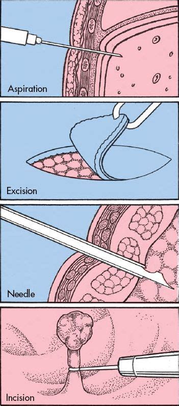 Types of Biopsies | Nclex, Medical school, Type