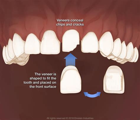 Veneers Lake Charles, LA - DeQuincy, LA - Sulphur, LA - Lake Area Dentistry