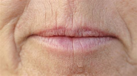 RHA Redensity Filler Improves Perioral Rhytids Up To 52 Weeks ...