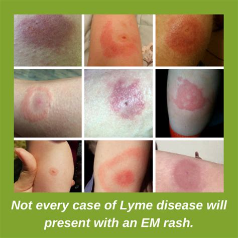 Identifying Lyme Disease Rash