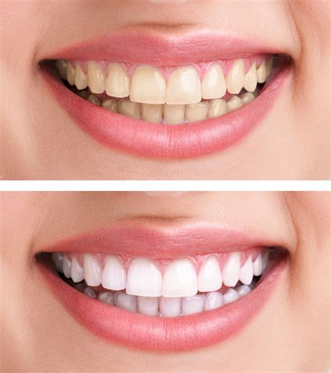 healthy teeth and smile - Longmont Complete Dentistry Blog