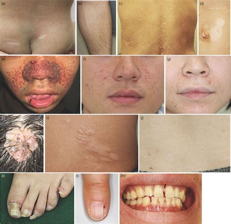 Thegriftygroove: Tuberous Sclerosis Skin Symptoms