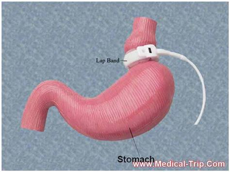 Lap Band Risks | Medical Trip