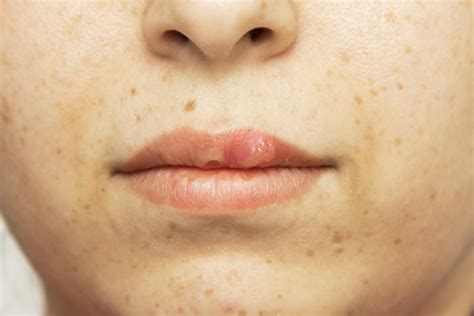 What Does A Herpes Sore Look Like Symptoms Pictures | Images and Photos ...