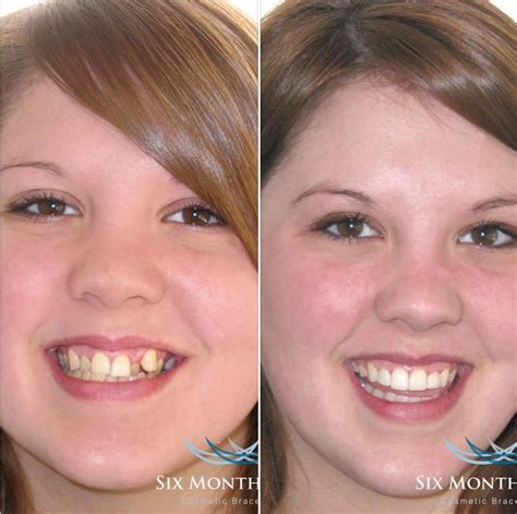 Before and After | Teeth straightening, Orthodontics, Orthodontist