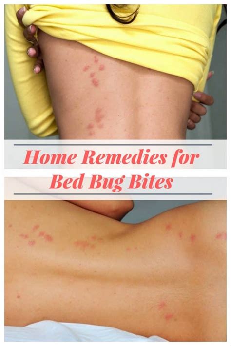 9 Effective Remedies to Get Rid of Bed Bug Bites