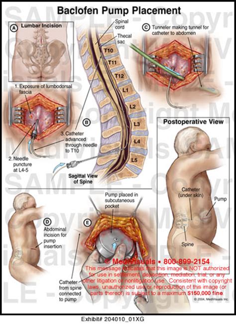 Baclofen Pump Placement Medical Illustration Medivisuals