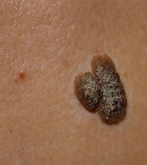 Seborrheic Keratosis Treatments | Sagebrush Dermatology