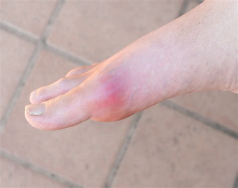 What Causes Severe Pain In The Ball Of The Foot? – My FootDr