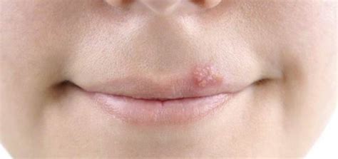 Pimple on Lip: 10 Causes and Natural Remedies | Daily Health Cures