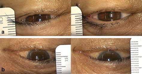 Representative cases of change in eyelid position before and after... | Download Scientific Diagram