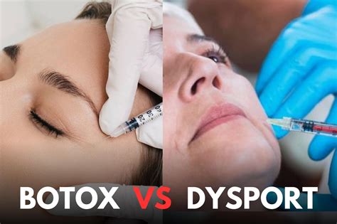 Botox Vs Dysport For Glabellar Lines - Fitness Beauty Art