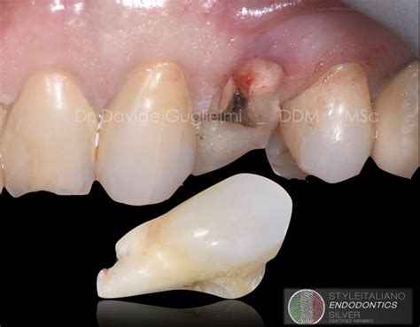 Treatment of an extensive radicular fracture: the pre-endodontic ...