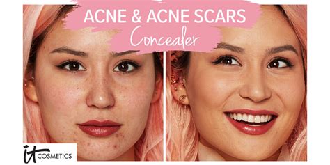 Scars - IT Cosmetics has the best products for acne scars