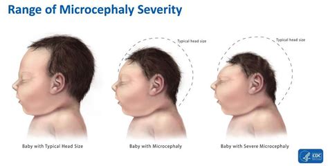 It's Official: Zika virus causes birth defects - News - Emirates24|7