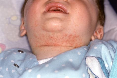 contact dermatitis baby neck - Agatha Greenlee