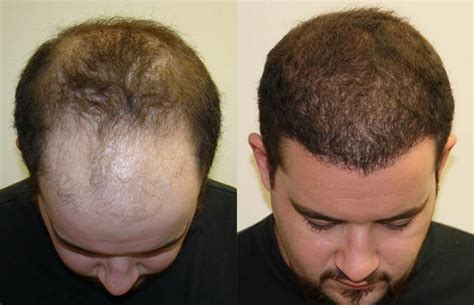 bosley hair transplant results - Jacki Mchenry