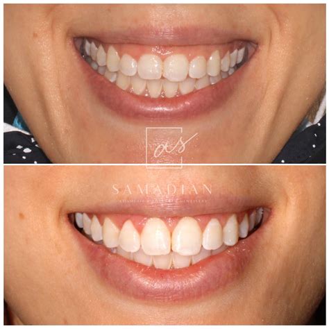 Laser Gum Contouring Before & After Photos | Samadian Cosmetic ...