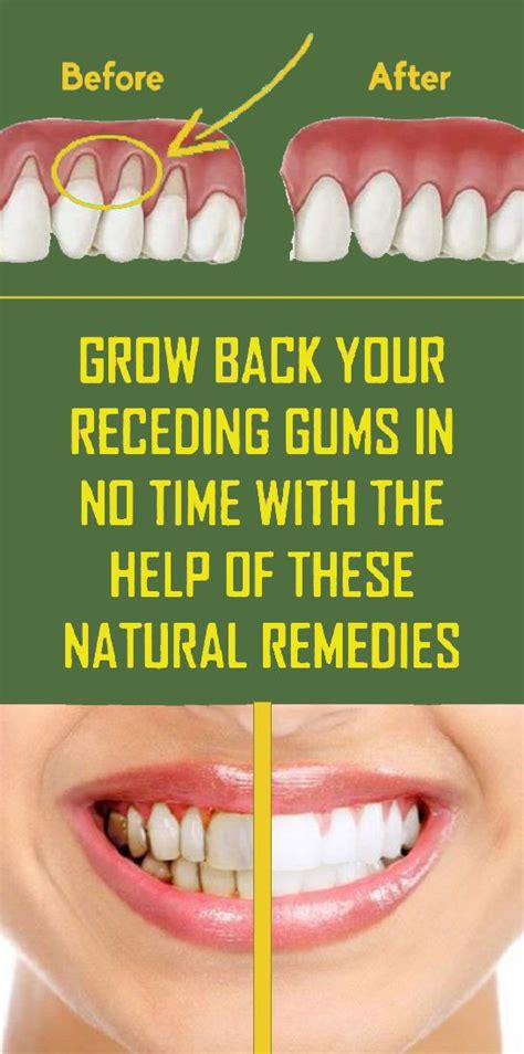 7 Natural Ways To Treat Receding Gums | Receding gums, Natural healing remedies