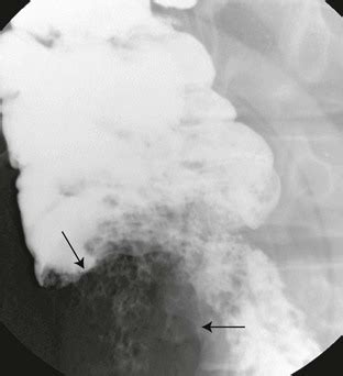 Intussusception | Radiology Key