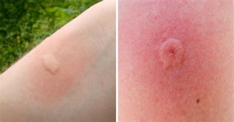 12 Common Bug Bites And How To Recognize Each One | Fly bites, Insect bites, Bug bites